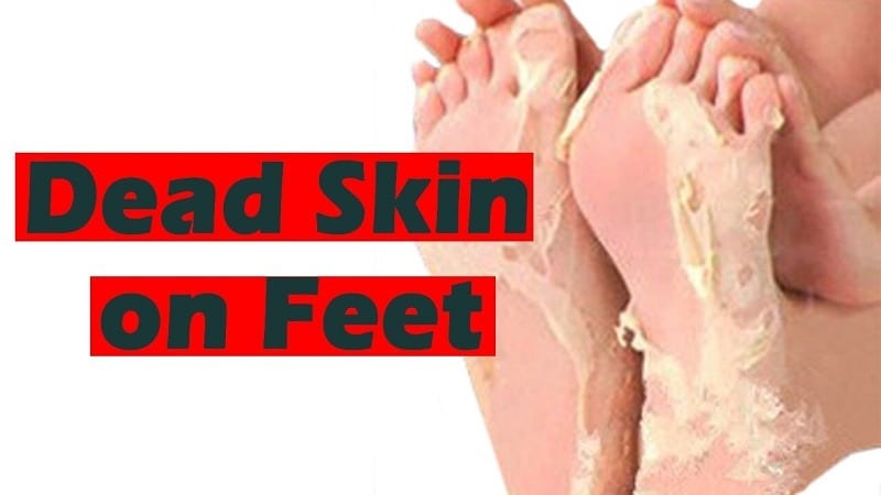 TOP 5 WAYS TO REMOVE DEAD SKIN FROM FEET NATURALLY